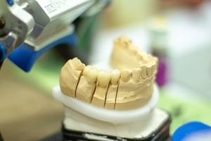 Вижте нашите зъбни импланти цени 23